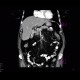 Cholecystolithiasis on CT: CT - Computed tomography