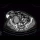 Gallstones, cholecystolithiasis, incisional hernia: CT - Computed tomography