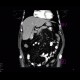 Cholecystolithiasis on CT: CT - Computed tomography