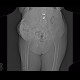 Gallstones, cholecystolithiasis, incisional hernia: CT - Computed tomography