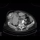 Gallstones, cholecystolithiasis, incisional hernia: CT - Computed tomography