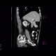 Cholecystolithiasis on CT: CT - Computed tomography