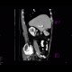 Cholecystolithiasis on CT: CT - Computed tomography