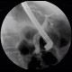 Choledocholithiasis, cholecystolithiasis, gallstones, biliary obstruction, ERCP: RF - Fluoroscopy