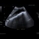 Choledocholithiasis, cholecystolithiasis, gallstones, biliary obstruction: US - Ultrasound