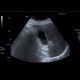 Cholesterolosis of gallbladder: US - Ultrasound