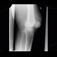 Chondromatosis of knee joint, effusion, fracture of femur, osteosynthesis: X-ray - Plain radiograph