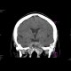 Chordoma: CT - Computed tomography