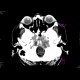 Chordoma: CT - Computed tomography