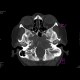 Chordoma: CT - Computed tomography