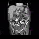 Chronic pancreatitis, dilated pancreatic duct: CT - Computed tomography