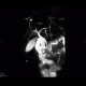 Chronic pancreatitis, dilated pancreatic duct, MRCP: MRI - Magnetic Resonance Imaging