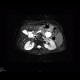 Chronic pancreatitis, dilated pancreatic duct: MRI - Magnetic Resonance Imaging