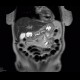 Chronic pancreatitis, dilated pancreatic duct: MRI - Magnetic Resonance Imaging