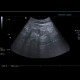 Chronic nephropathy: US - Ultrasound