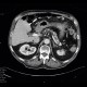 Chronic calcified pancreatitis: CT - Computed tomography