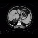 Myelolipoma of adrenal gland, liver cirrhosis, portal vein thrombosis: CT - Computed tomography