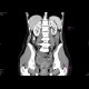 Corpus luteum cyst: CT - Computed tomography