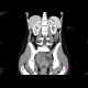 Corpus luteum cyst: CT - Computed tomography