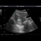 Corpus luteum cyst: US - Ultrasound