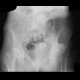 Coxarthrosis, advanced: X-ray - Plain radiograph
