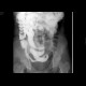 Crohn's disease of aboral ileum, enteroclysis: RF - Fluoroscopy