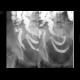 Crohn's disease of aboral ileum, enteroclysis: RF - Fluoroscopy