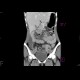 Crohn's disease of terminal ileum, CT, postoperative: CT - Computed tomography