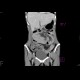 Crohn's disease of terminal ileum, CT, postoperative: CT - Computed tomography