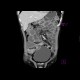 Crohn's disease, enterovesical fistula: CT - Computed tomography