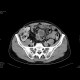 Crohn's disease with absesses, fistulae, and sacroileitis: CT - Computed tomography