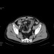 Crohn's disease with abscesses, fistulae, and sacroileitis: CT - Computed tomography