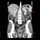 Crohn's disease, acute inflammation, ascites, CT enterography: CT - Computed tomography