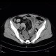 Crohn's disease, acute inflammation, ascites, CT enterography: CT - Computed tomography