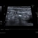 Crohn's disease, acute inflammation, ascites: US - Ultrasound