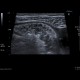 Crohn's disease, acute inflammation, ascites: US - Ultrasound