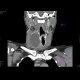 Cyst of the thyroid gland: CT - Computed tomography
