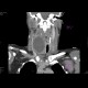 Cyst of the thyroid gland: CT - Computed tomography