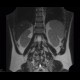 Cystic nephroma, Perlmann's tumour, hemangioma of liver: MRI - Magnetic Resonance Imaging