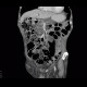 Intrapapillary mucinous neoplasm of pancreas, IPMN, central IPMN: CT - Computed tomography