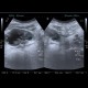 Cystitis, acute cystitis: US - Ultrasound