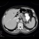 Pancreatic cysts and renal cysts in von Hippel-Lindau disease: CT - Computed tomography