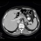 Pancreatic cysts and renal cysts in von Hippel-Lindau disease: CT - Computed tomography