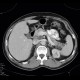 Pancreatic cysts and renal cysts in von Hippel-Lindau disease: CT - Computed tomography