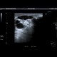 Breast cyst: US - Ultrasound