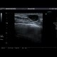 Breast cyst: US - Ultrasound