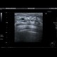 Breast cyst: US - Ultrasound