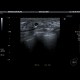 Breast cyst: US - Ultrasound