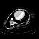Scoliosis of thoracic spine, severe: CT - Computed tomography