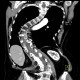 Scoliosis of thoracic spine, severe: CT - Computed tomography